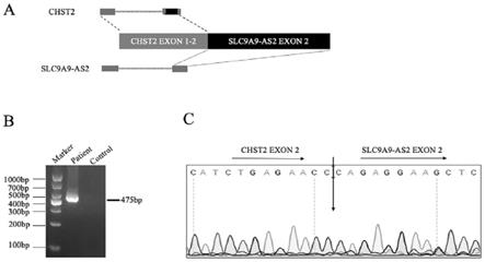 一种CHST2-SLC9A9-AS2融合基因及其应用和检测试剂盒的制作方法