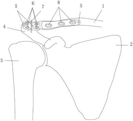 一种针对肩锁关节脱位的解剖锁定装置的制作方法